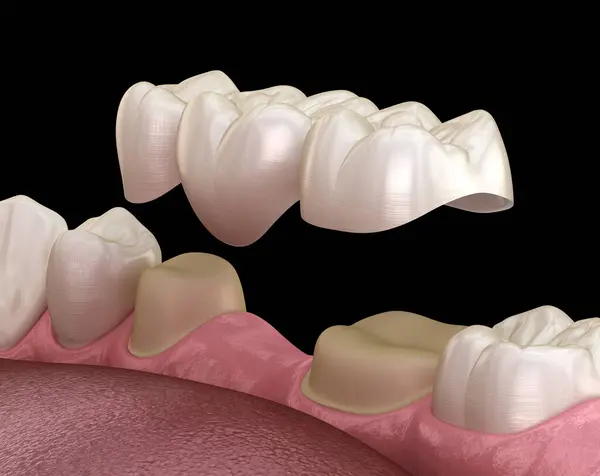 Are Dental Implants Worth It in Chandler, AZ? Benefits and Long-Term Value