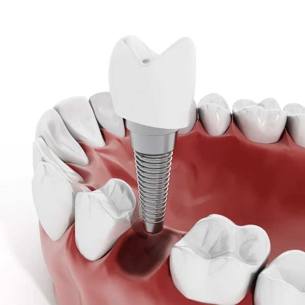 How Long Dental Implants Last: What Chandler, AZ Patients Should Know