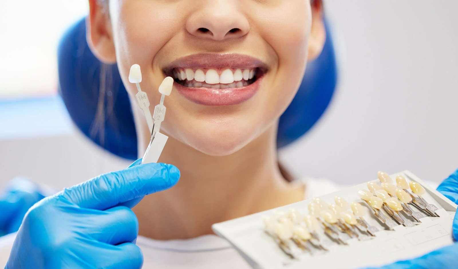 Dental Veneers