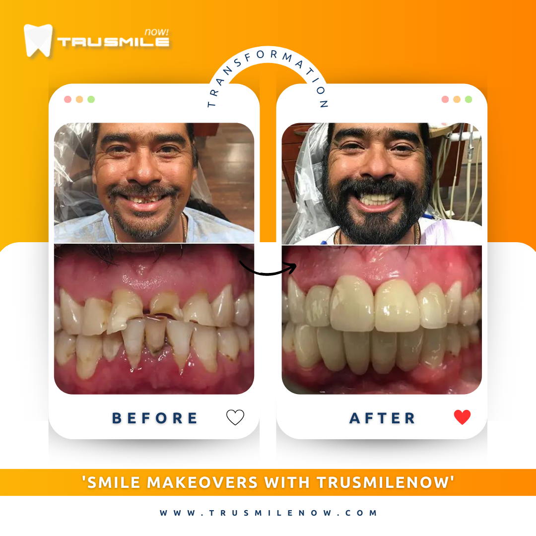 All-on-4 dental implants before and after results - Trusmile Now Ahwatukee AZ