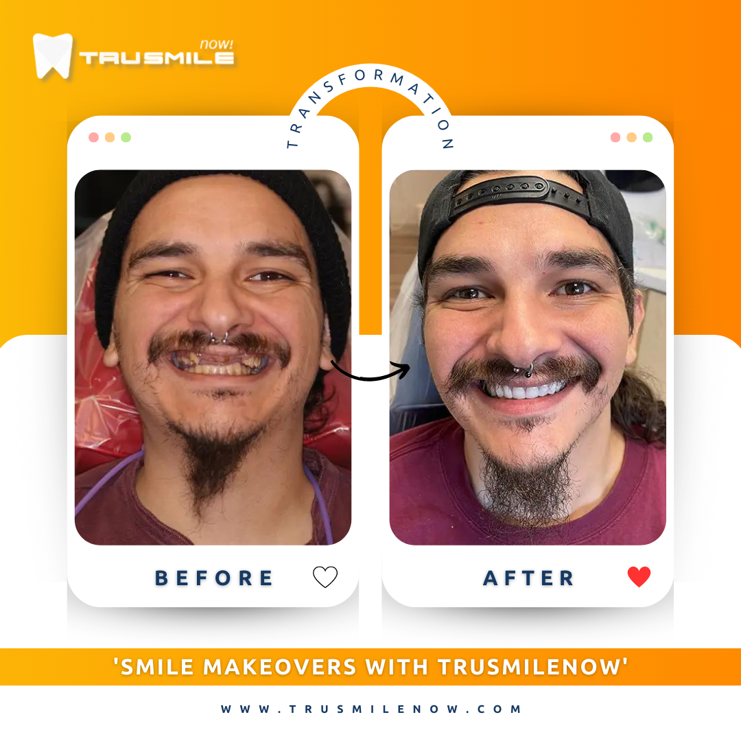All-on-4 dental implants before and after - full mouth restoration at Trusmile Now Arizona