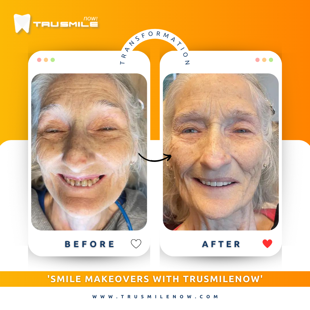 Full mouth dental implants before and after - smile restored at Trusmile Now Phoenix